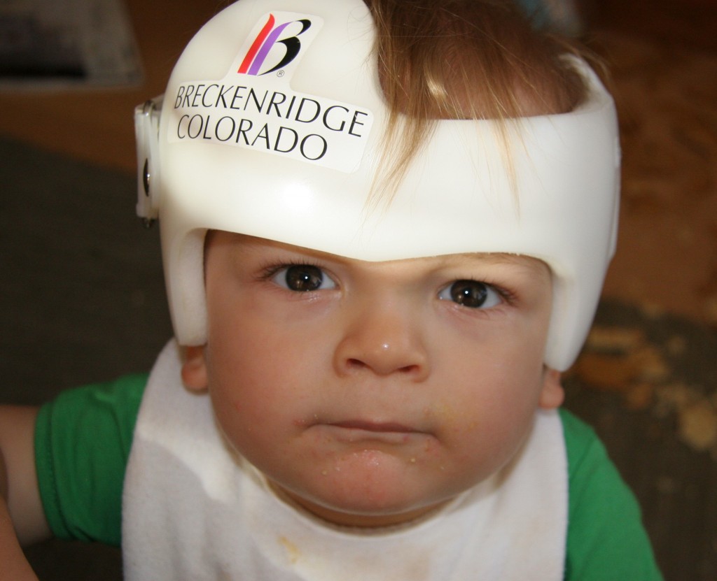 Is the Head Round? Baby helmets may help “Flat Head Syndrome” BabyScience